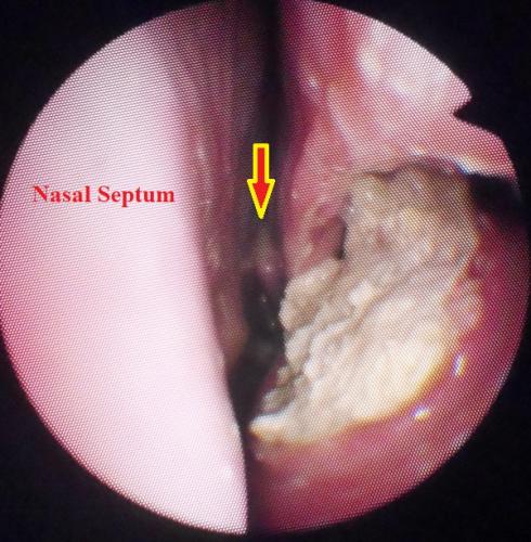 Pus in the nose secondary to dental sinusitis. (Ventral Conchal Sinus)