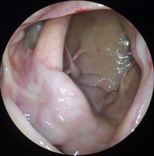 Looking down into Caudal Sinus Compartment. (Frontal Portal) 