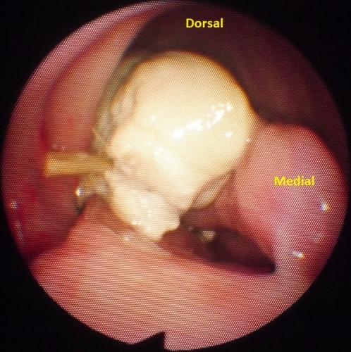 Pus & Grass in Rostral Sinus Compartment (Frontal Portal) 